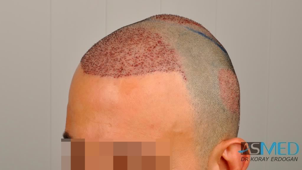 Norwood5 4876-grafts-FUE-2811-FUE-2065-FUE ffafdb4f