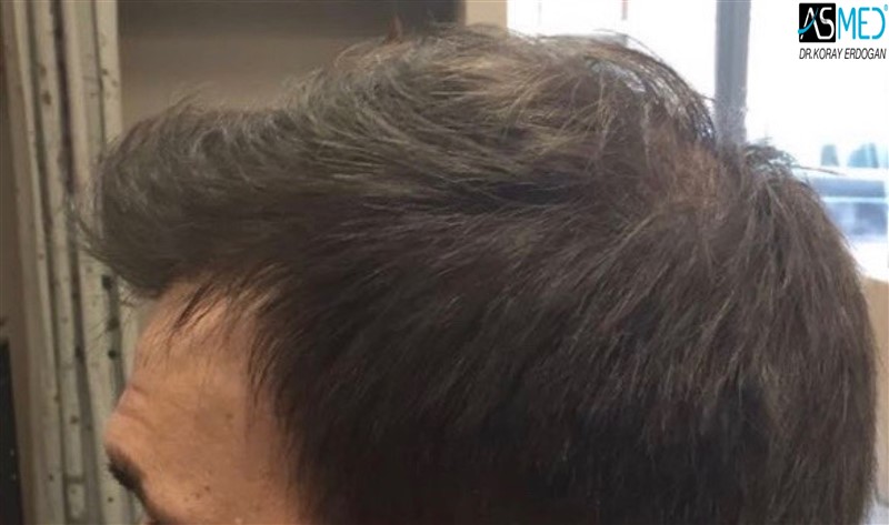 Norwood5 5000-grafts-FUE 1year7months V2_2016-08-18-PHOTO-00000027aaa