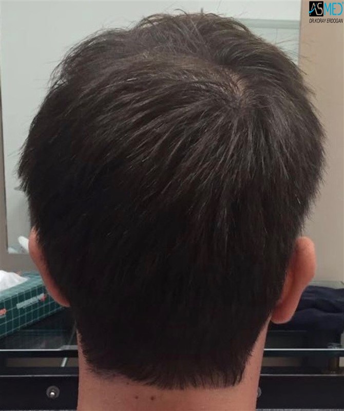Norwood5 5000-grafts-FUE 1year7months V2_2016-08-18-PHOTO-00000028aaa