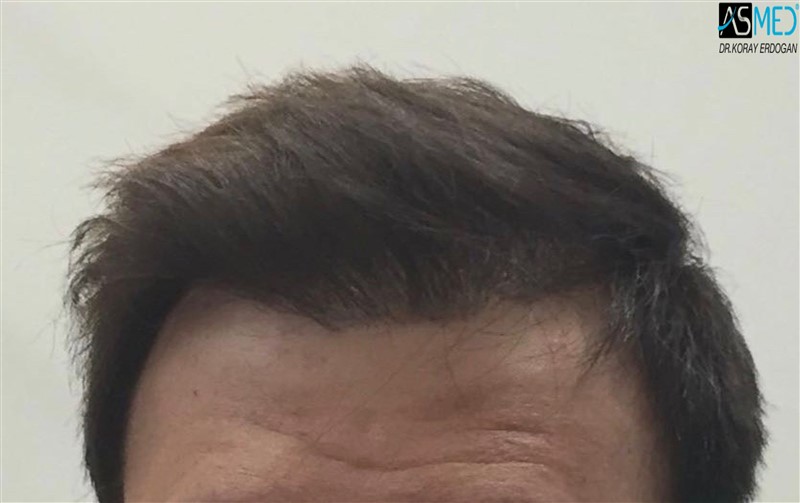 Norwood5 5000-grafts-FUE 1year7months V2_2016-08-18-PHOTO-00000030aaa