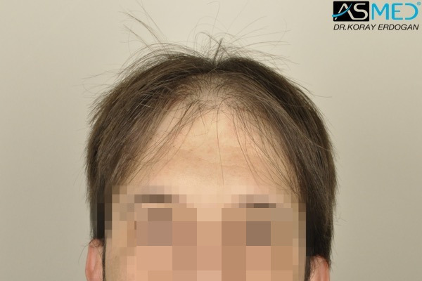 Norwood5 5000-grafts-FUE V2__DSC3339_zpsowm2fqnq