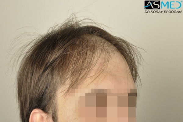 Norwood5 5000-grafts-FUE V2__DSC3341_zpspbvp0fs5