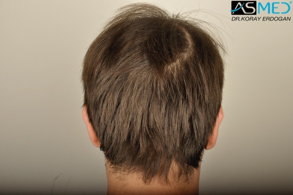 Norwood5 5000-grafts-FUE V2__DSC3346_zpsk9puopey