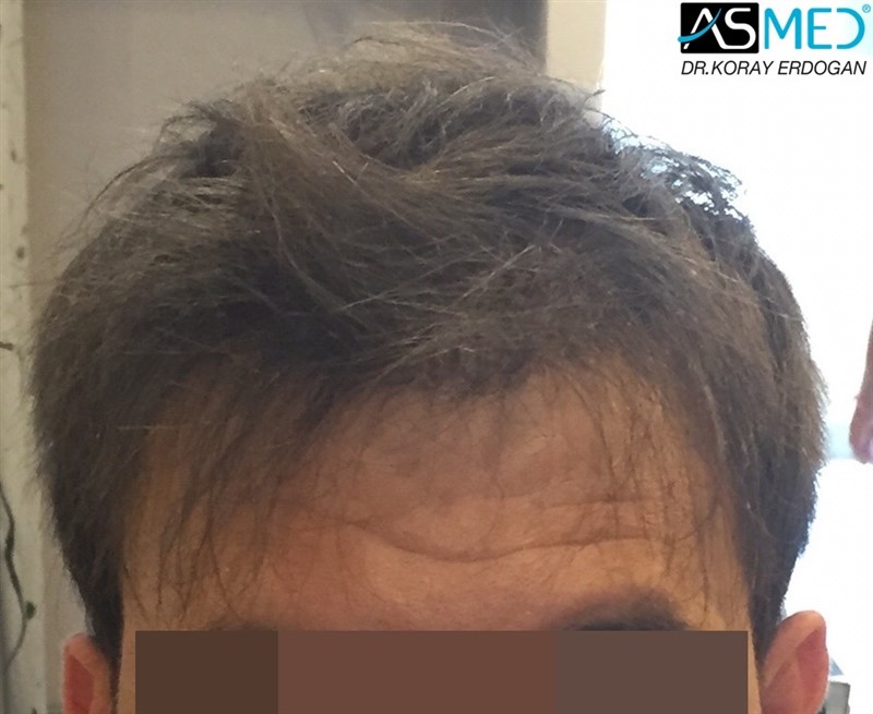 Norwood5 5000-grafts-FUE acb26167dd7ab4d989b70741e8b6a0f5%201_new_zpso69dz6tn