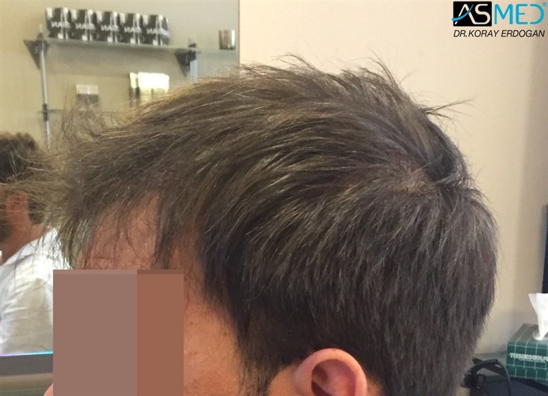Norwood5 5000-grafts-FUE ea4aa896837cb9ebd171c974ccdc2e21%201_new_zps40zbfrqz