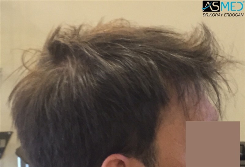 Norwood5 5000-grafts-FUE eec66418b74414110ec346125e8a9e32%201_new_zpshosmw9qh