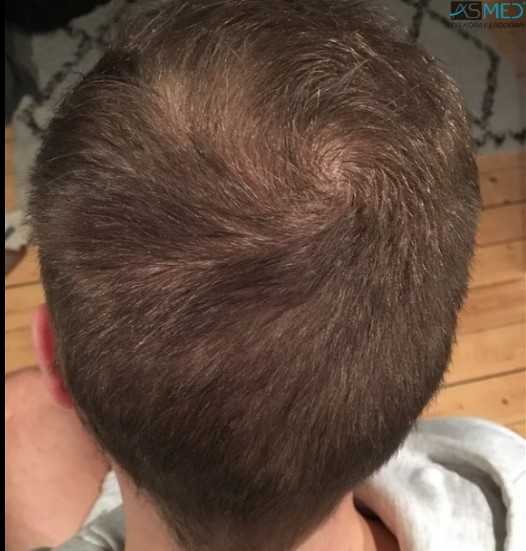 Norwood5 5007-grafts-FUE 8months after_new