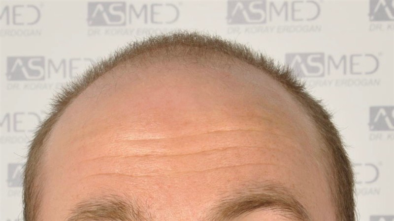 Norwood5 5007-grafts-FUE before 1