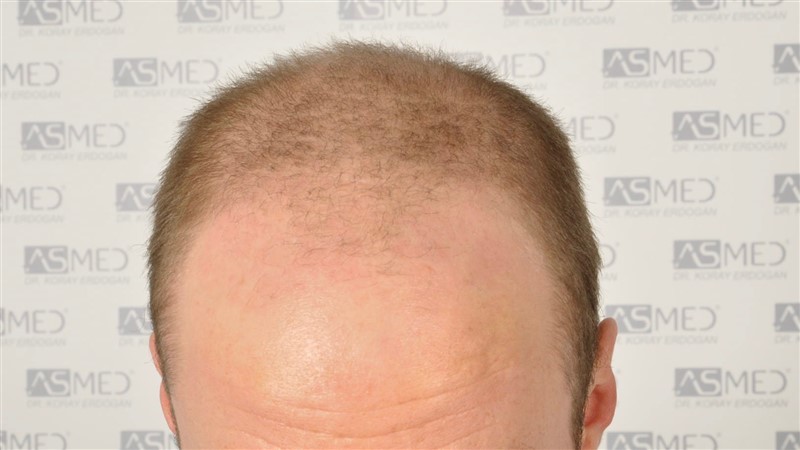 Norwood5 5007-grafts-FUE before 2