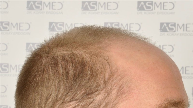 Norwood5 5007-grafts-FUE before 3
