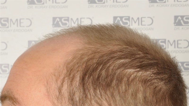 Norwood5 5007-grafts-FUE before 4