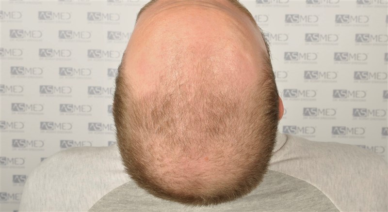 Norwood5 5007-grafts-FUE before 5