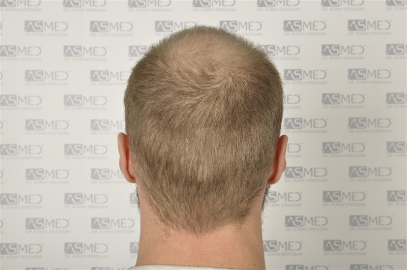 Norwood5 5007-grafts-FUE before 6