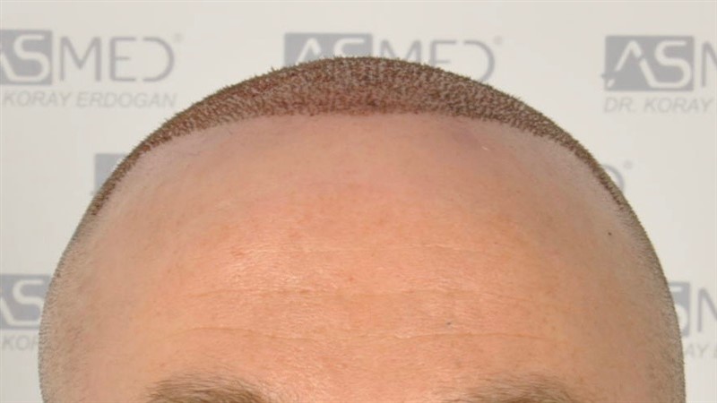 Norwood5 5007-grafts-FUE operation 1