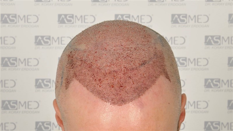 Norwood5 5007-grafts-FUE operation 2