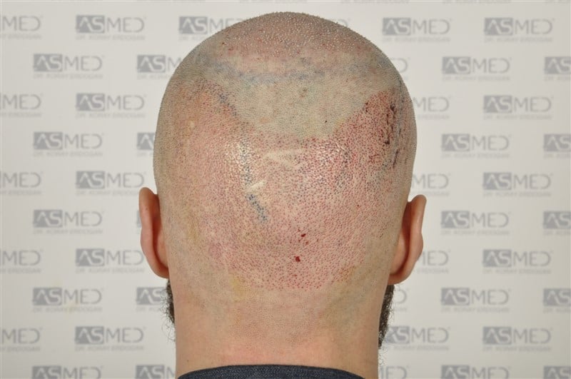 Norwood5 5007-grafts-FUE operation 6