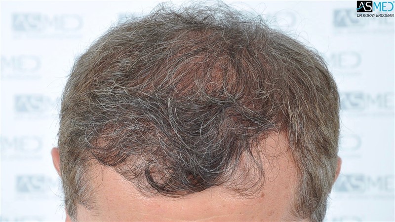 Norwood5 5011-grafts-FUE 1year 2_new