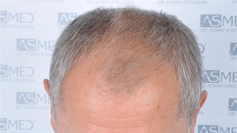 Norwood5 5011-grafts-FUE before 2