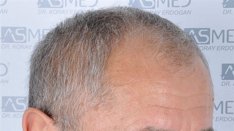 Norwood5 5011-grafts-FUE before 3