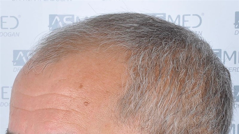 Norwood5 5011-grafts-FUE before 4