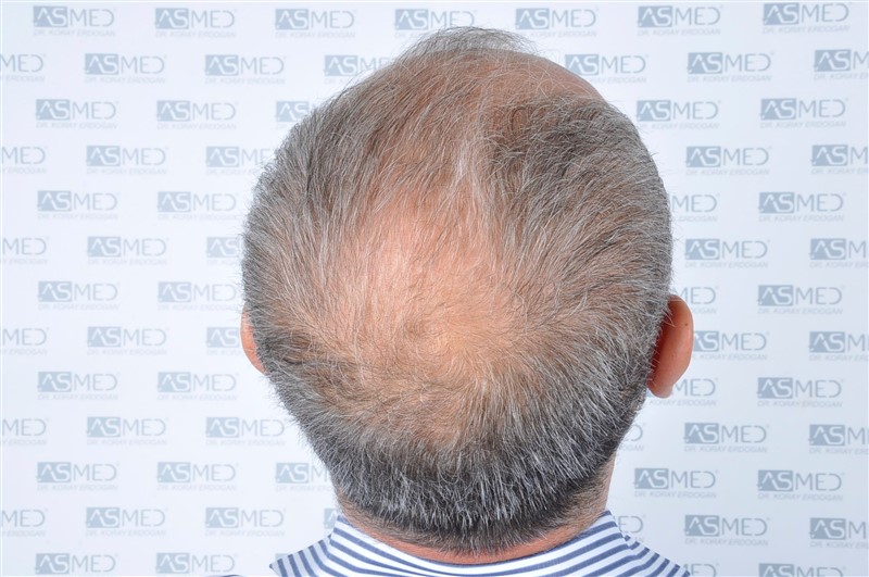 Norwood5 5011-grafts-FUE before 6