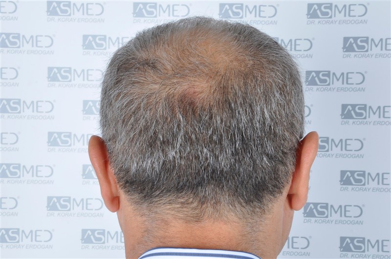 Norwood5 5011-grafts-FUE before 7