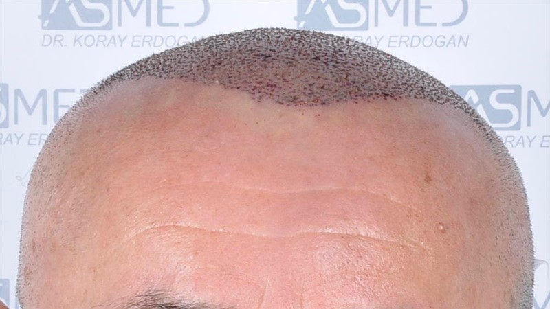 Norwood5 5011-grafts-FUE operation 1