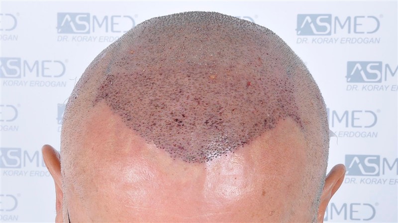 Norwood5 5011-grafts-FUE operation 2