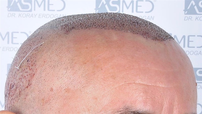 Norwood5 5011-grafts-FUE operation 3