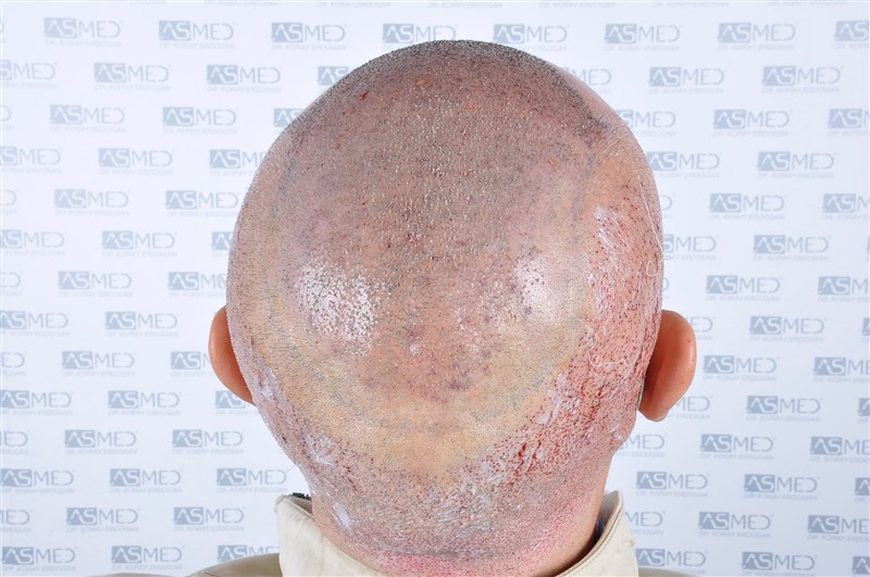 Norwood5 5011-grafts-FUE operation 6