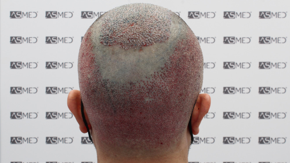 Norwood5 5016-grafts-fue 12
