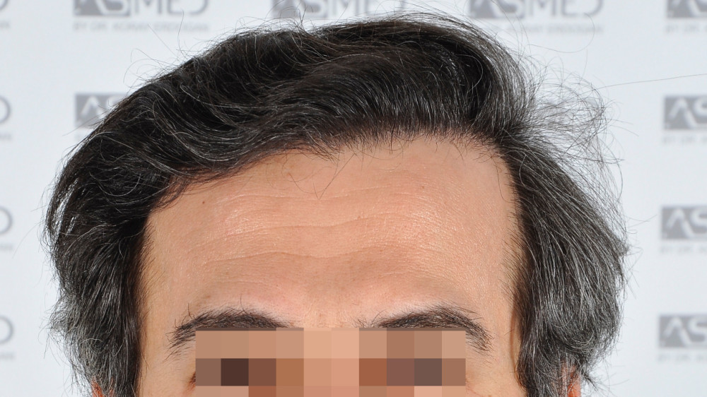 Norwood5 5016-grafts-fue 13