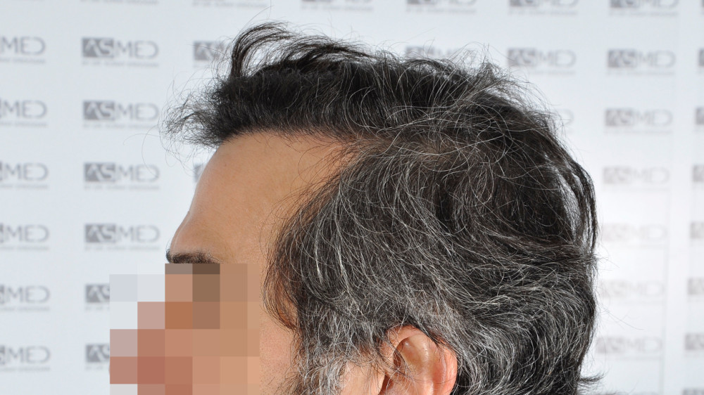 Norwood5 5016-grafts-fue 15