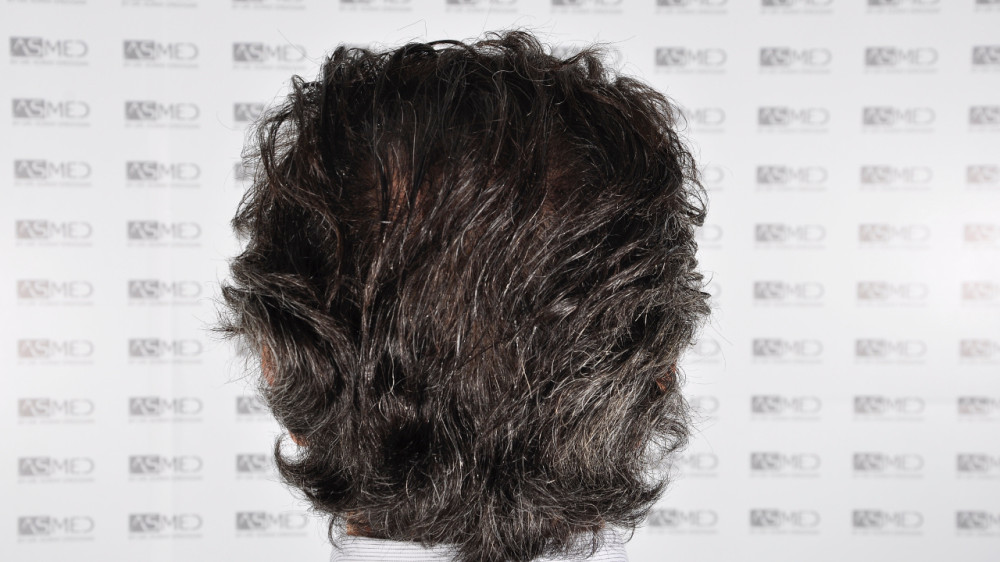 Norwood5 5016-grafts-fue 18