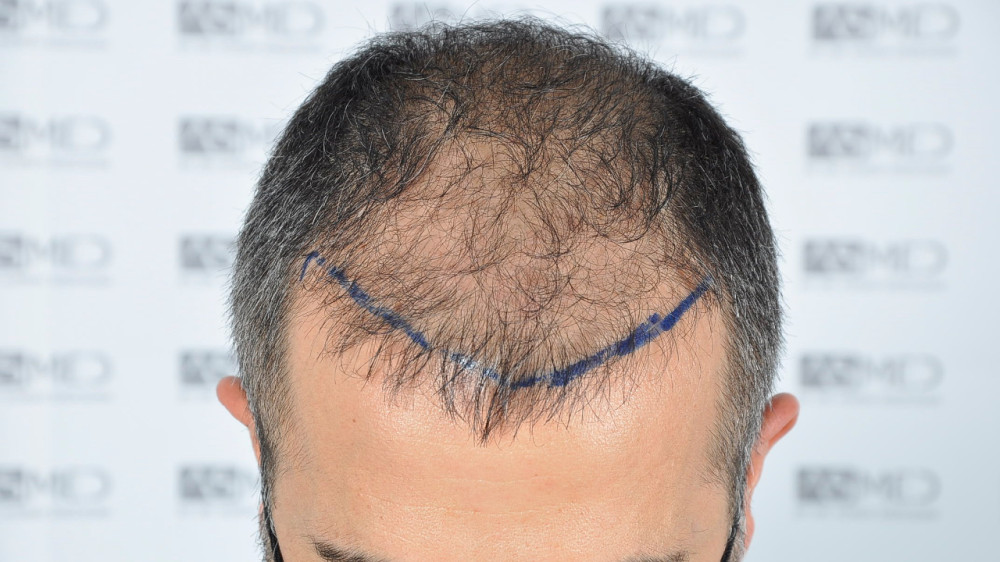 Norwood5 5016-grafts-fue 2