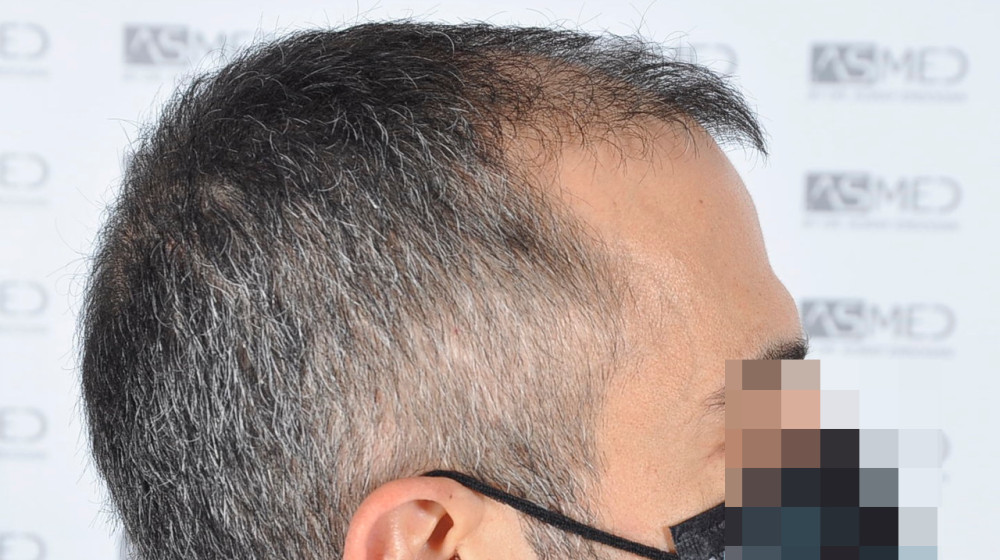 Norwood5 5016-grafts-fue 3