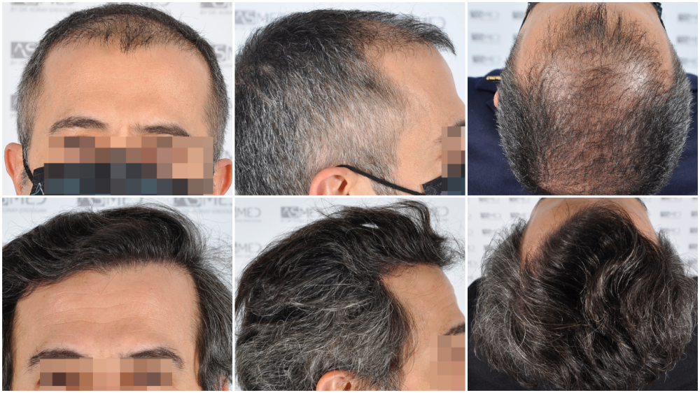 Norwood 5 Hair Transplantation Results | Asmed Hair Transplant Norwood 5 Hair Transplantation Results | Asmed Hair Transplant