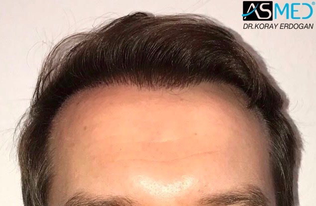 https://www.hairtransplantfue.org/asmed-hair-transplant-result/upload/Norwood5/5021-grafts-fue/15months/IMG-0262_new.jpg