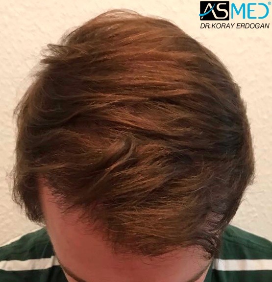 https://www.hairtransplantfue.org/asmed-hair-transplant-result/upload/Norwood5/5021-grafts-fue/15months/IMG-0264_new.jpg