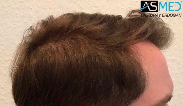 https://www.hairtransplantfue.org/asmed-hair-transplant-result/upload/Norwood5/5021-grafts-fue/15months/IMG-0265_new.jpg