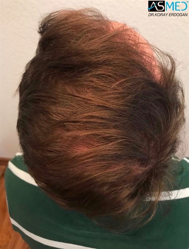 https://www.hairtransplantfue.org/asmed-hair-transplant-result/upload/Norwood5/5021-grafts-fue/15months/IMG-0268_new.jpg