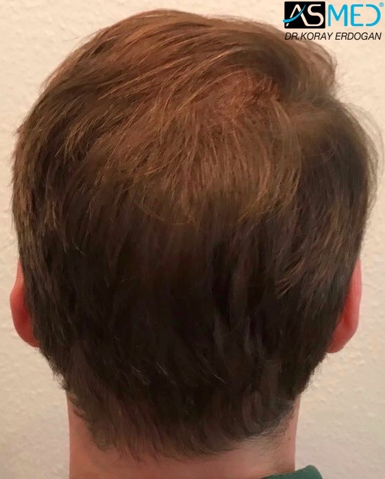 https://www.hairtransplantfue.org/asmed-hair-transplant-result/upload/Norwood5/5021-grafts-fue/15months/IMG-0269_new.jpg