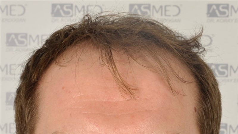 https://www.hairtransplantfue.org/asmed-hair-transplant-result/upload/Norwood5/5021-grafts-fue/before/_DSC6302.jpg