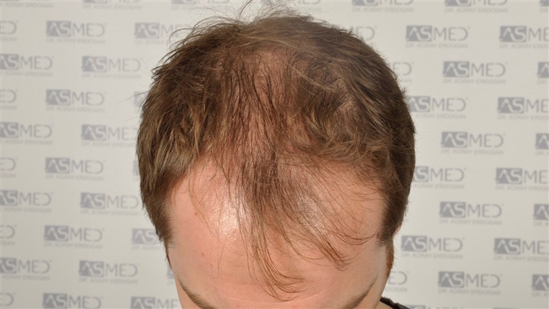 https://www.hairtransplantfue.org/asmed-hair-transplant-result/upload/Norwood5/5021-grafts-fue/before/_DSC6303.jpg