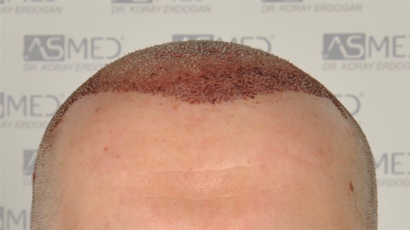 https://www.hairtransplantfue.org/asmed-hair-transplant-result/upload/Norwood5/5021-grafts-fue/operation/_DSC6675.jpg