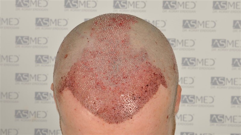 https://www.hairtransplantfue.org/asmed-hair-transplant-result/upload/Norwood5/5021-grafts-fue/operation/_DSC6676.jpg