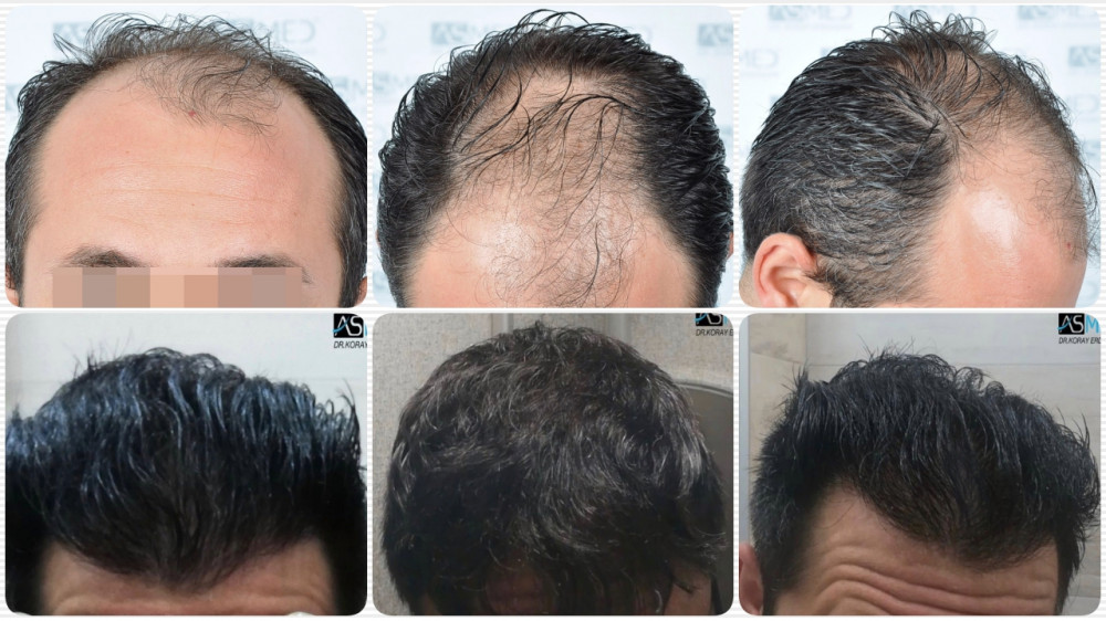 Norwood 5 Hair Transplantation Results Asmed Hair Transplant