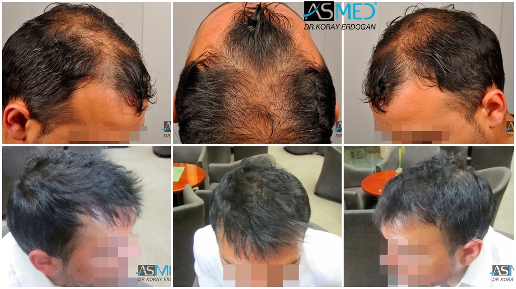 Results Norwood 6 Asmed Hair Transplant