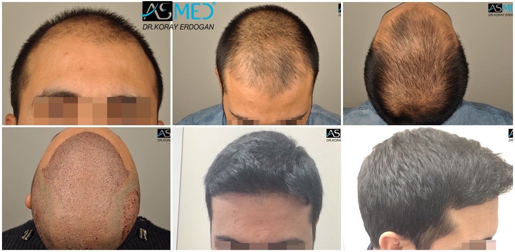 Asmed Hair Transplant Results Gallery Norwood 6 Norwood 6 Dr Koray Erdogan 4004 Grafts Fue