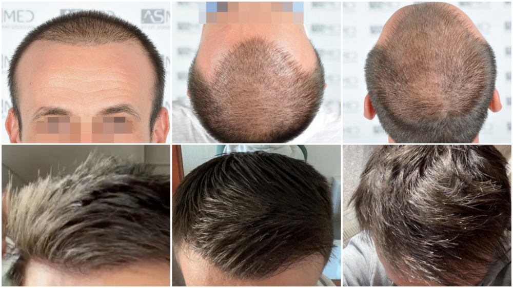 8. Fine Blonde Hair Transplant Results - wide 6